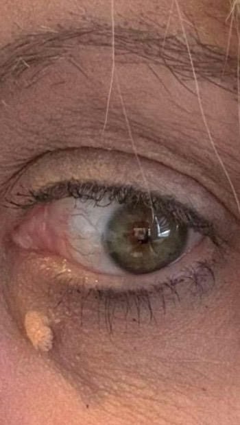 Before: skin tag under the lower eyelid