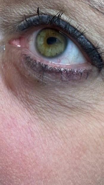 Healed: smooth skin under the eye