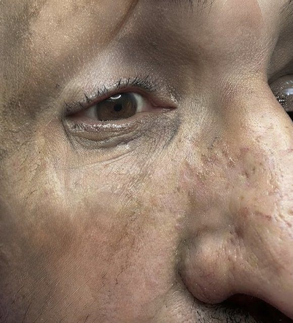 After: smooth skin beside the nose