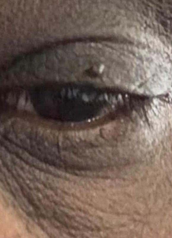 Before: single skin tag on the upper eyelid